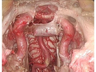 Hipofiz Ameliyatı Nasıl Yapılır? Hipofiz Ameliyatı Nasıl Yapılır?